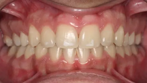 After treatment: deep bite