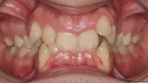 Before treatment: deep bite