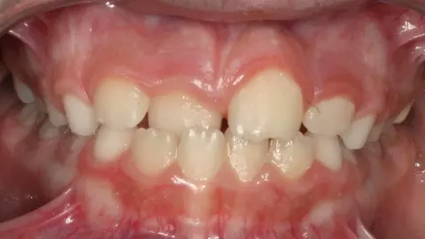 Before treatment: crossbite