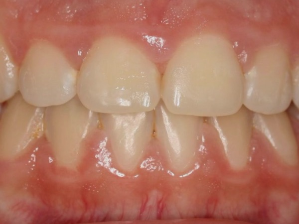 Example: the teeth together, seen from the front